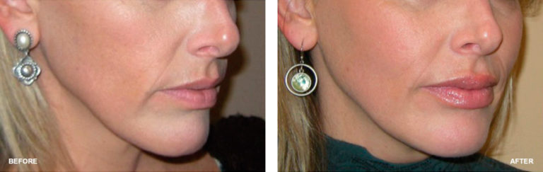Artefill before and after nose job